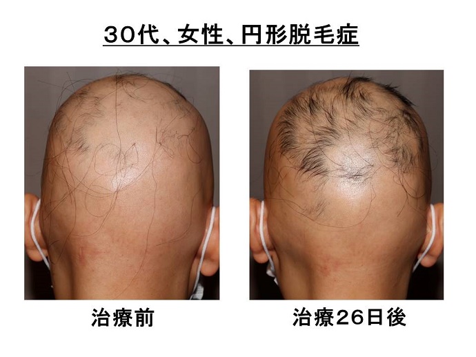 円形脱毛症　病院
